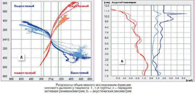 Результаты риноманометрии